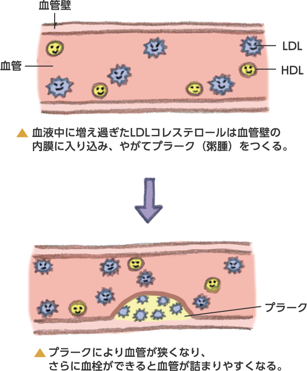 脂質異常症の説明：血液中に増え過ぎたLDLコレステロールは血管壁の内膜に入り込み、やがてプラーク（粥腫）をつくる。　動脈硬化の説明：プラークにより血管が狭くなり、さらに血栓ができると血管が詰まりやすくなる。